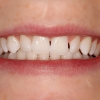 Composite Bonding - Smile 19 before